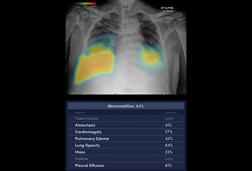 AIを用いた胸部レントゲン「CXR-AID」を導入
